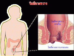 โรคริดสีดวงทวาร