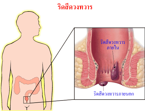 โรคริดสีดวงทวาร