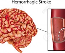 โรคหลอดเลือดสมองแตก (Haemorrhagic Stroke) แขนอ่อนแรง ปัญหาทางการพูด