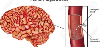 โรคหลอดเลือดสมองแตก (Haemorrhagic Stroke) แขนอ่อนแรง ปัญหาทางการพูด